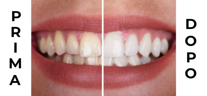 Prima dopo denti