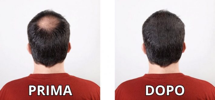 Alopecia prima dopo 1500 x 700